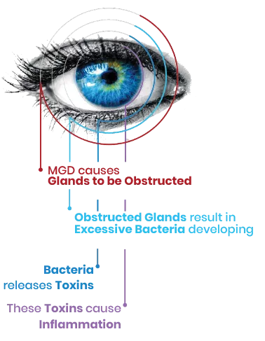 Dry Eyes - What Is Meibomian Gland Dysfunction - Clear Perspective Eyecare, Albuquerque, NM