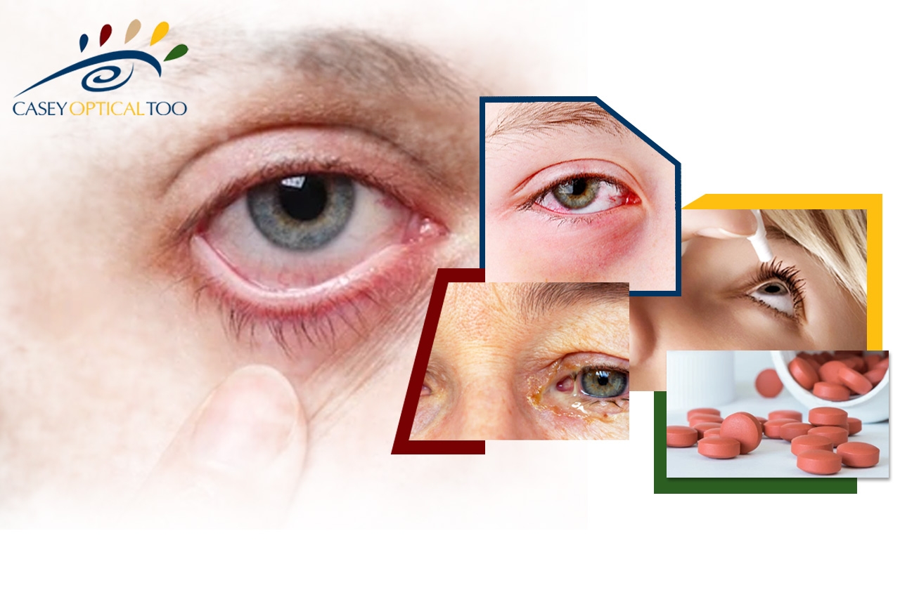 Eye Allergies: Causes, Symptoms and Treatment