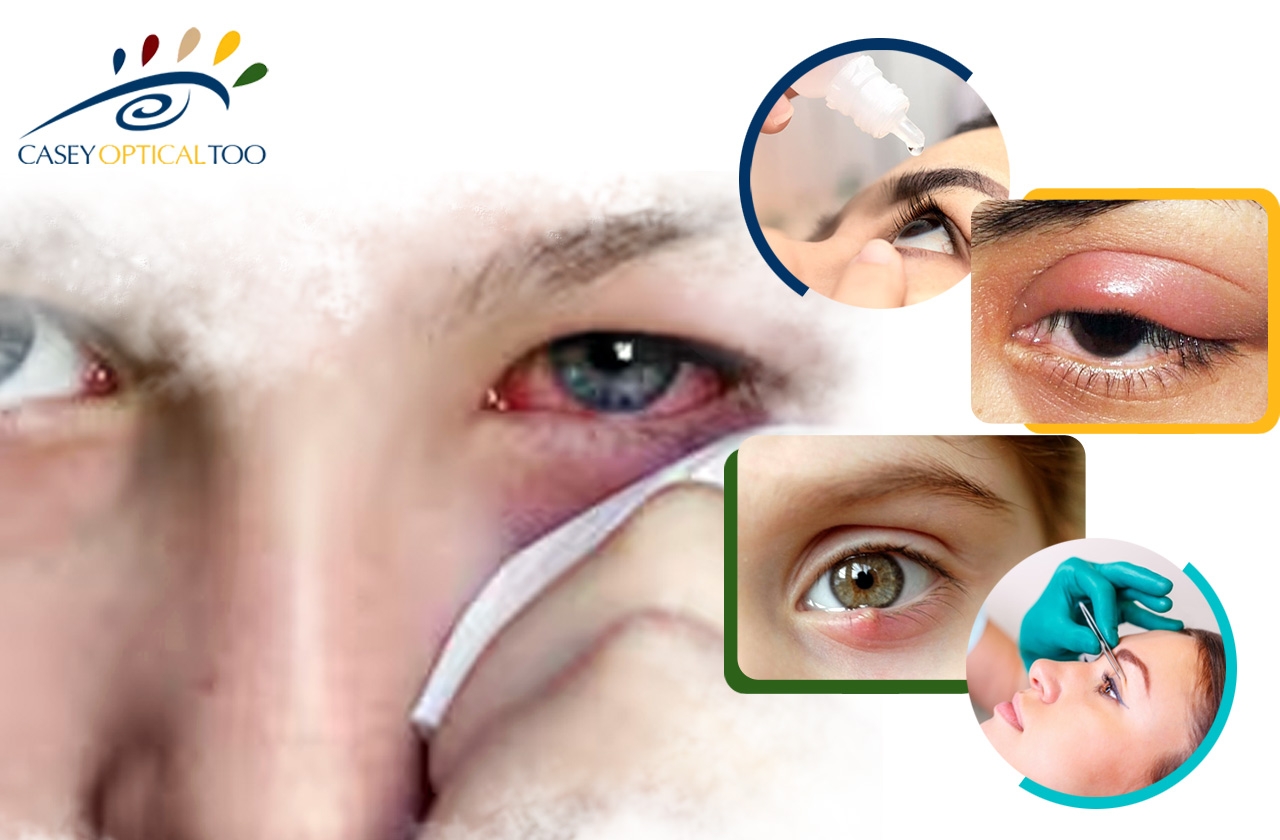 Swollen Eyelids: Causes, Symptoms and Treatments