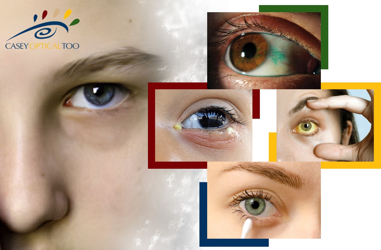 Eye Discharge: Causes and Treatment