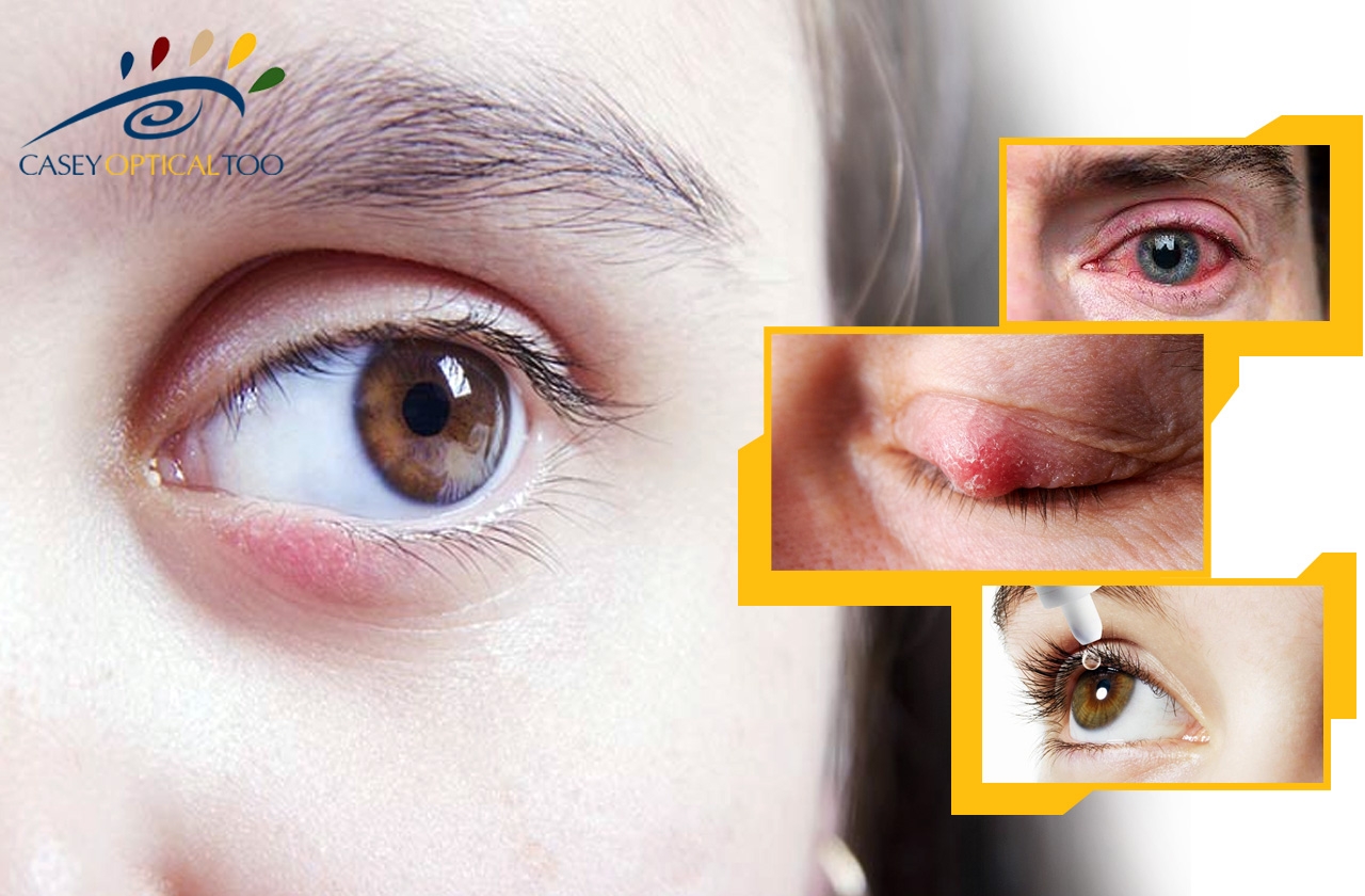 Chalazion: Causes and Treatment of Eyelid Bumps