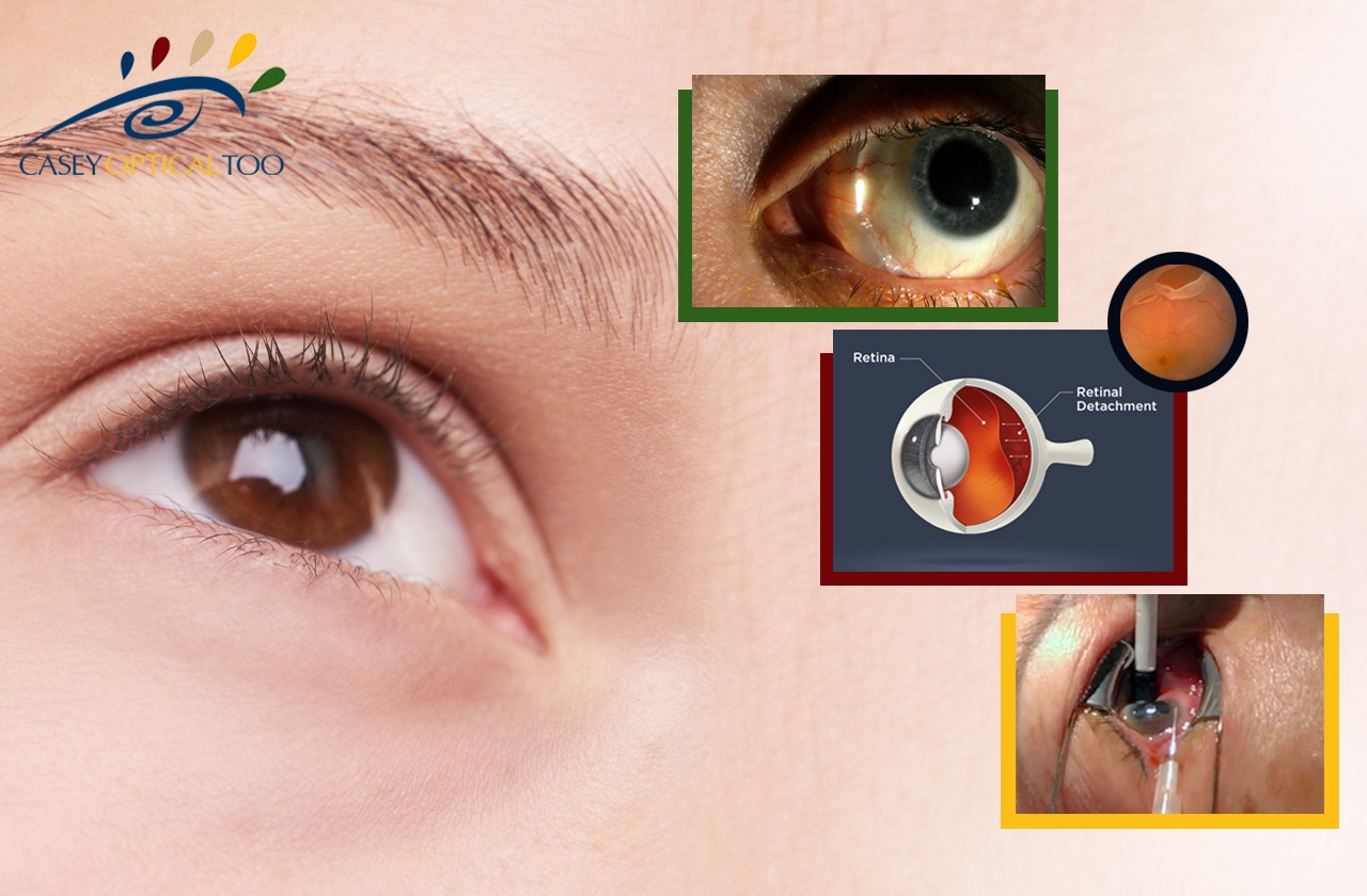 The Causes, Signs, and Treatments For Detached Retina