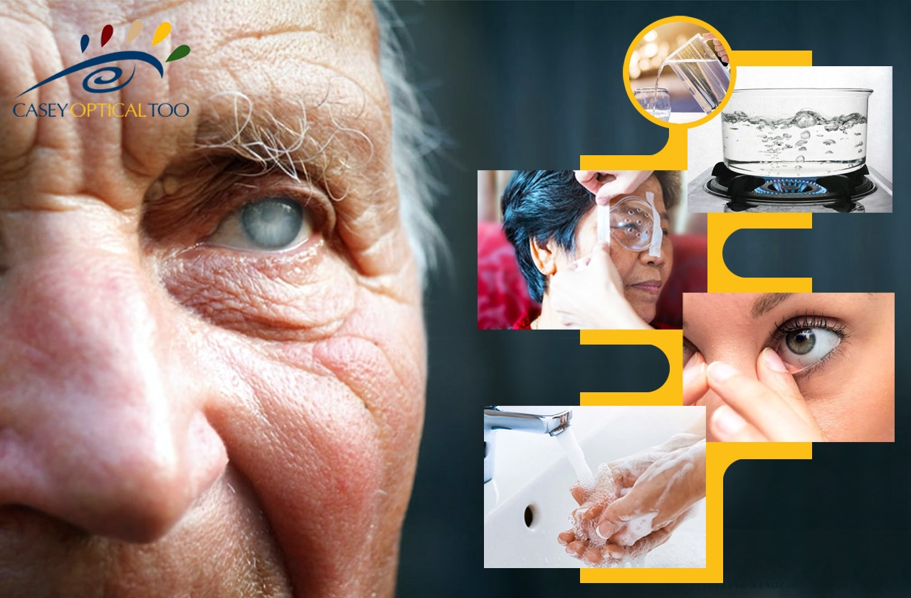 Recovery and Care After Cataract Surgery