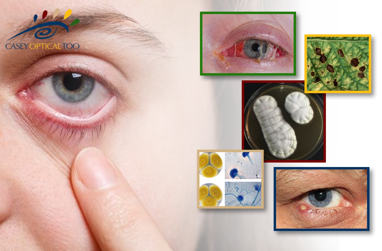 Eye Infections: Types, Causes, and Signs