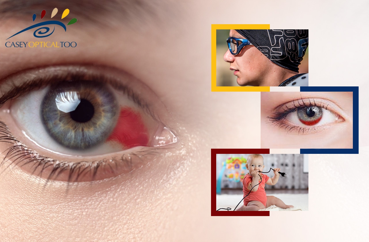 Facts About Internal Eye Bleeding During Hyphema