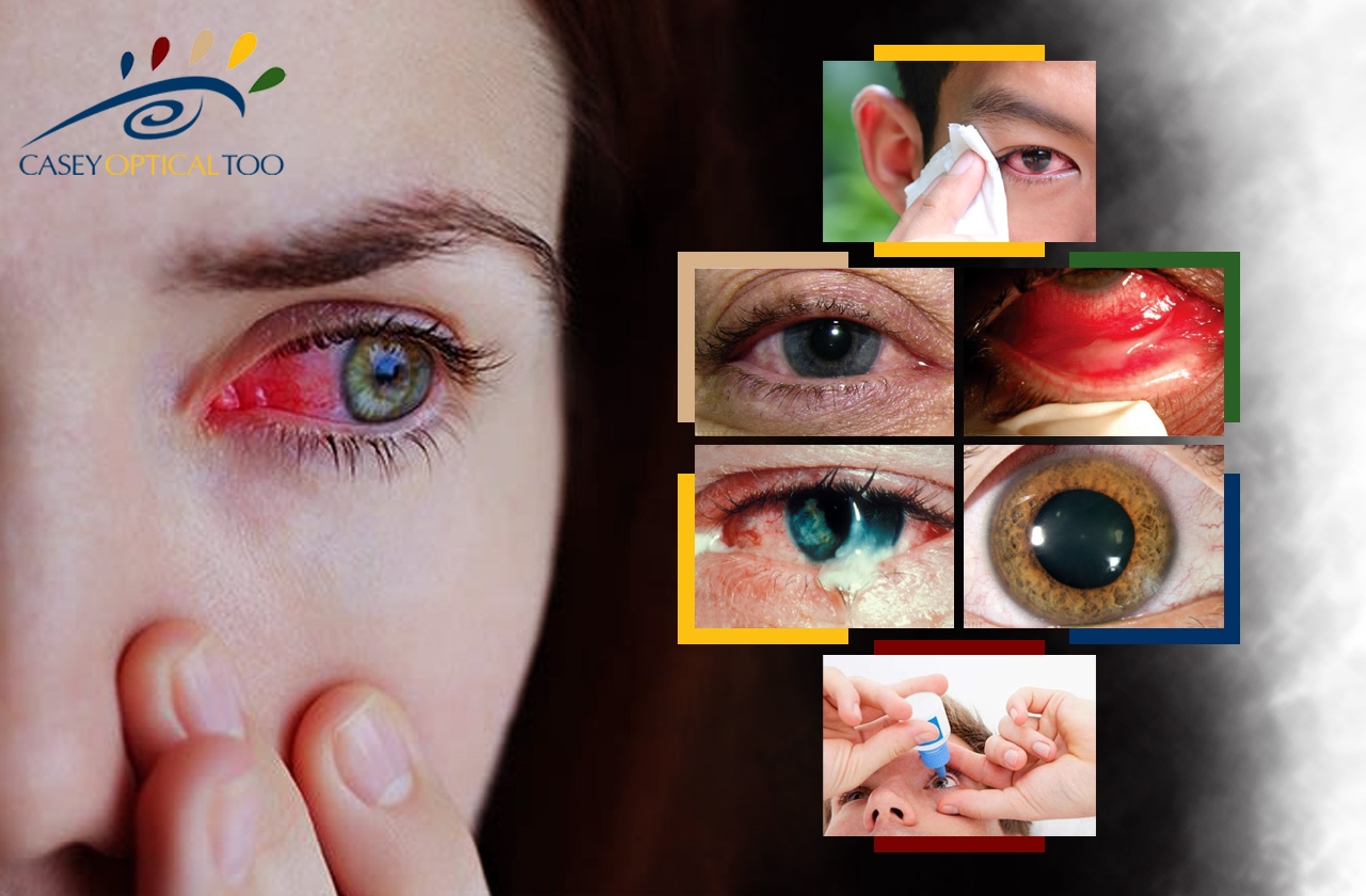 Red Eyes: A Symptom of Coronavirus or Allergies?