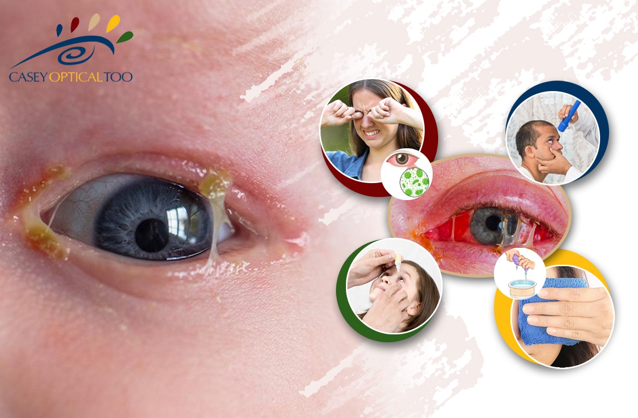 Exploring the Spectrum of Conjunctivitis: Bacterial, Viral, Allergic, and Beyond