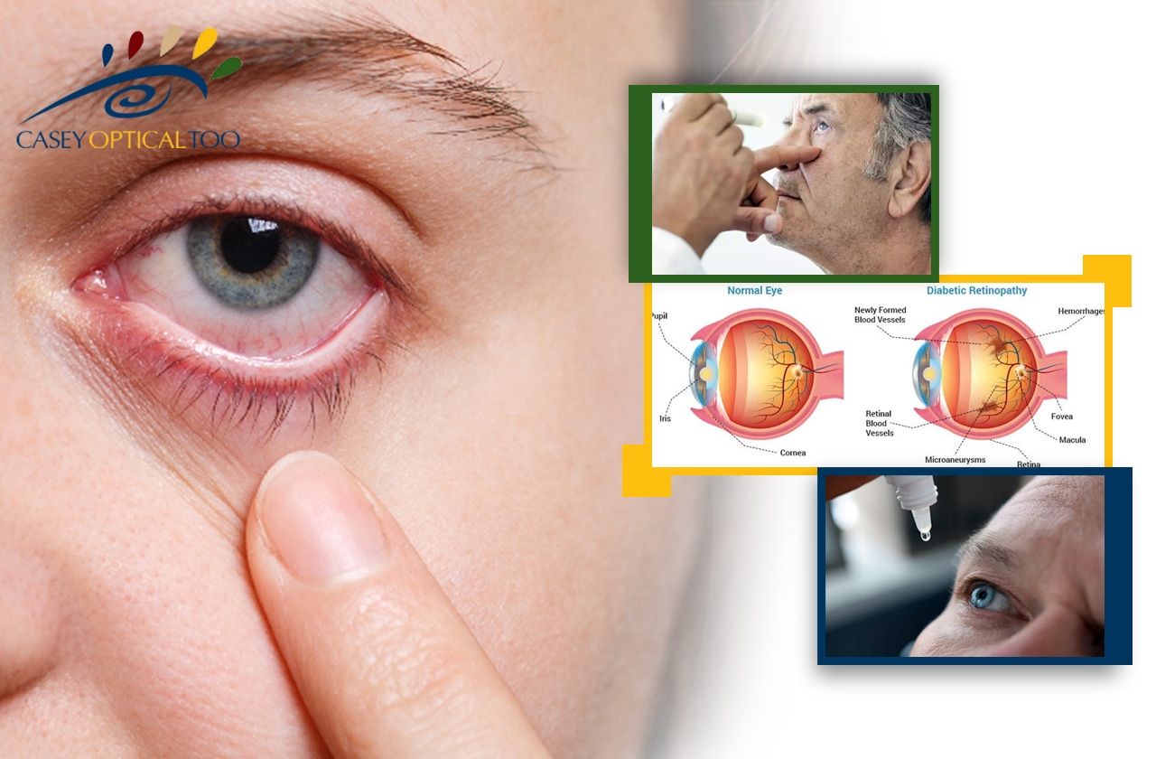 The Intricate Connection Between Diabetes and Glaucoma: Unravelling the Silent Threat to Vision