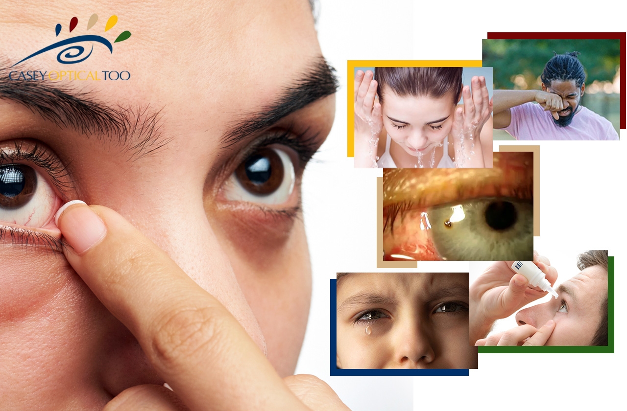 Guide to Safely Removing Foreign Objects from Your Eye